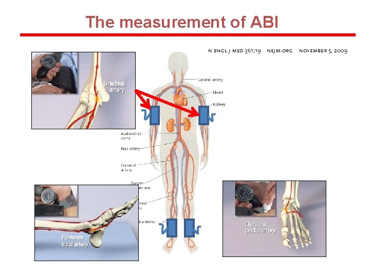 The measurement of ABI 