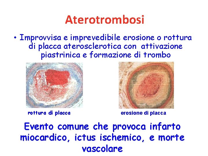 Aterotrombosi • Improvvisa e imprevedibile erosione o rottura di placca aterosclerotica con attivazione piastrinica