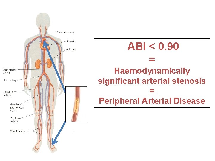 ABI < 0. 90 = Haemodynamically significant arterial stenosis = Peripheral Arterial Disease 