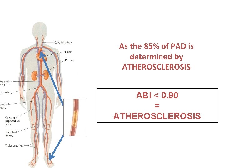 As the 85% of PAD is determined by ATHEROSCLEROSIS ABI < 0. 90 =