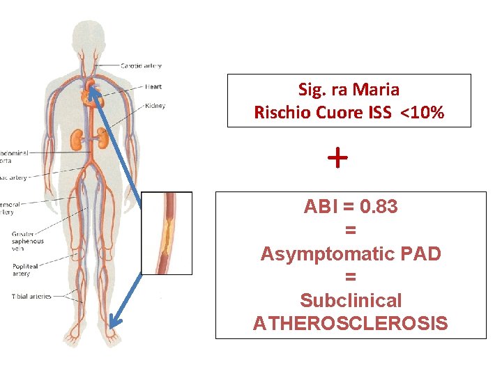 Sig. ra Maria Rischio Cuore ISS <10% + ABI = 0. 83 = Asymptomatic