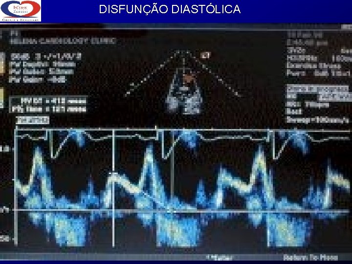 DISFUNÇÃO DIASTÓLICA 