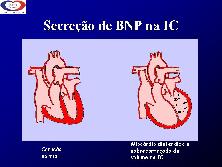 Secreção de BNP na IC BNP BNP Coração normal Miocárdio distendido e sobrecarregado de