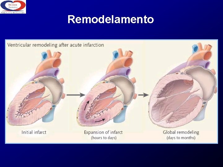 Remodelamento 