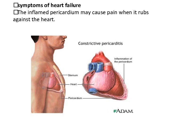 �symptoms of heart failure �The inflamed pericardium may cause pain when it rubs against