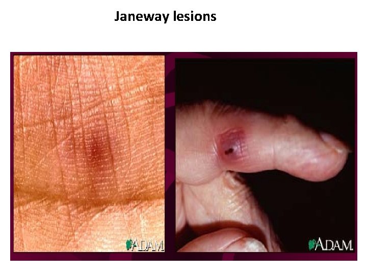 Janeway lesions 