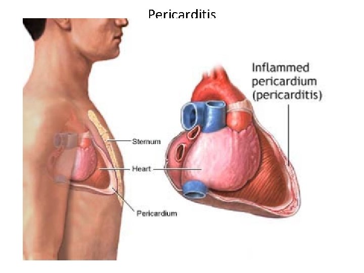 Pericarditis 