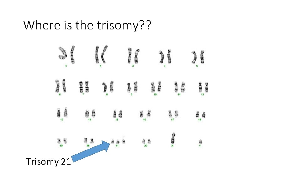 Where is the trisomy? ? Trisomy 21 