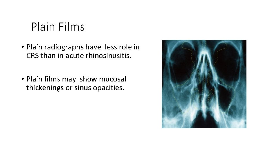 Plain Films • Plain radiographs have less role in CRS than in acute rhinosinusitis.