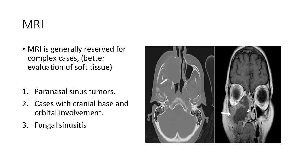 MRI • MRI is generally reserved for complex cases, (better evaluation of soft tissue)