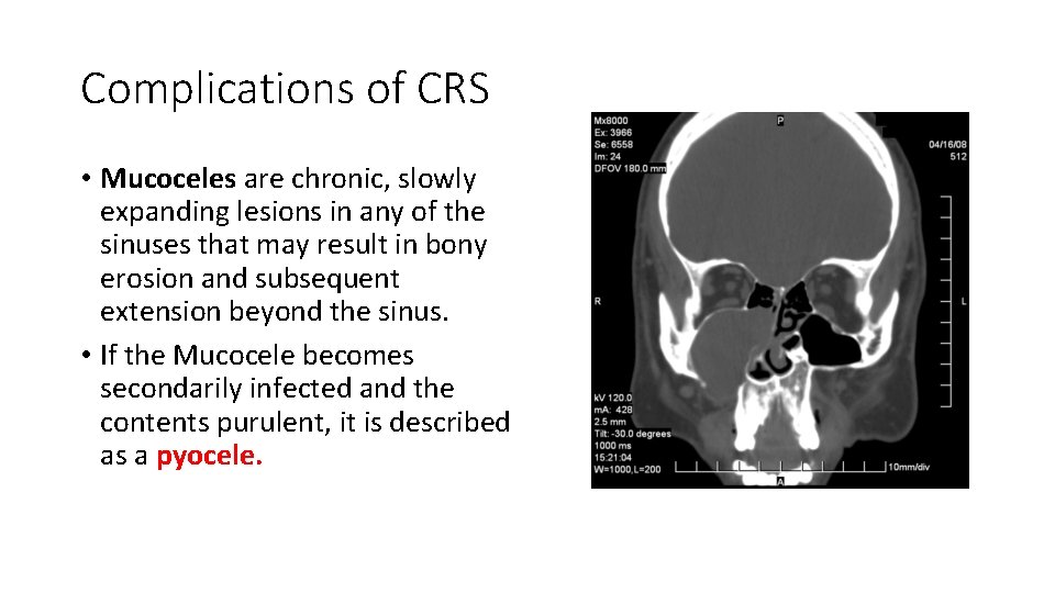 Complications of CRS • Mucoceles are chronic, slowly expanding lesions in any of the