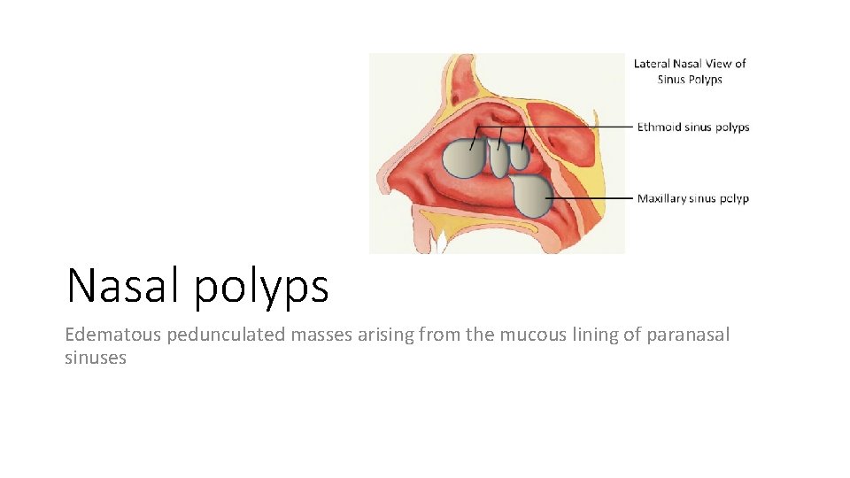 Nasal polyps Edematous pedunculated masses arising from the mucous lining of paranasal sinuses 