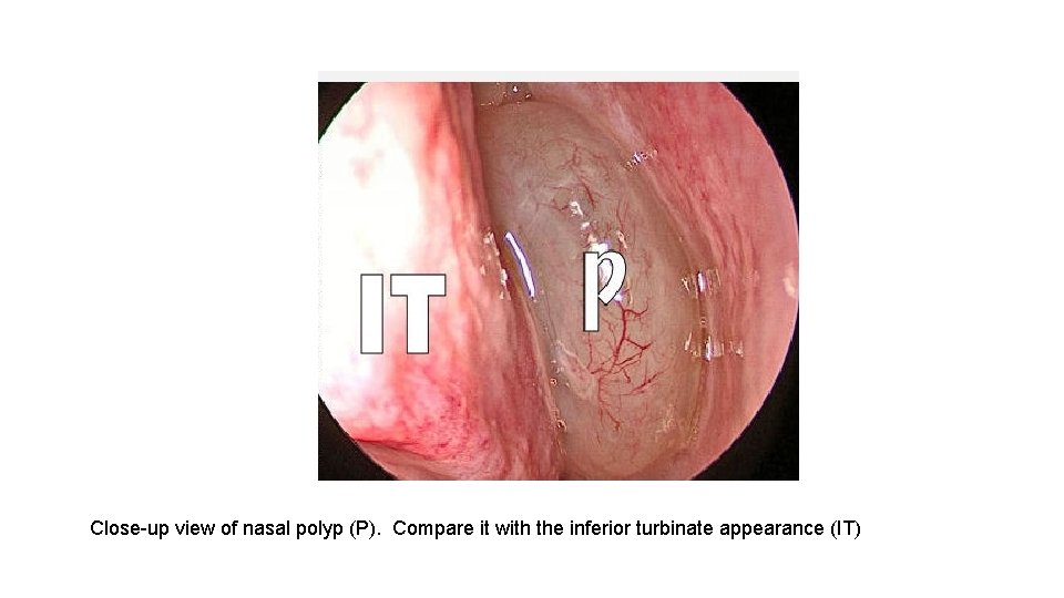 Close-up view of nasal polyp (P). Compare it with the inferior turbinate appearance (IT)