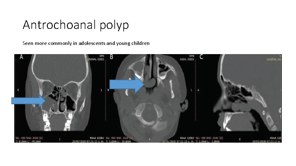 Antrochoanal polyp Seen more commonly in adolescents and young children 