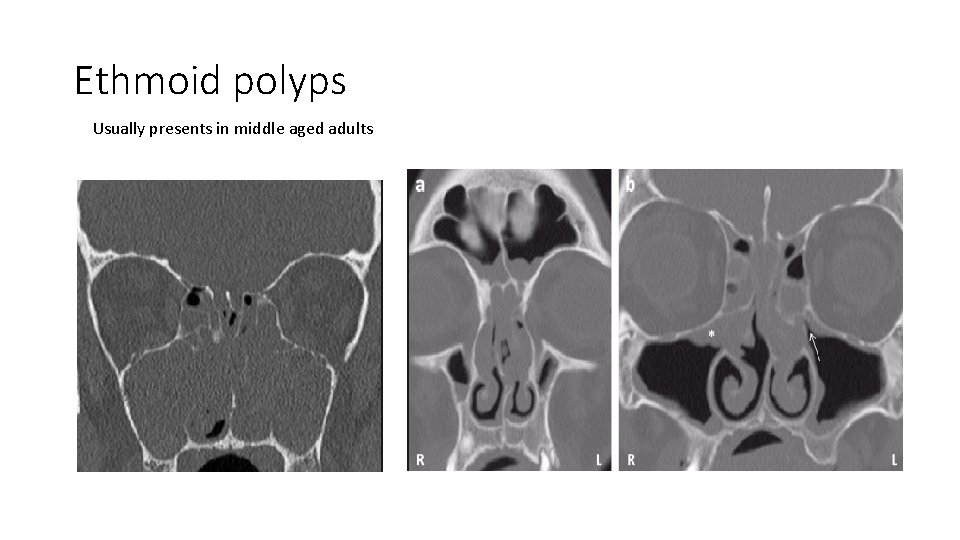 Ethmoid polyps Usually presents in middle aged adults 