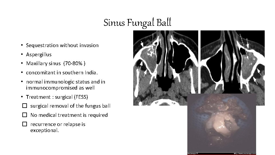 Sinus Fungal Ball • Sequestration without invasion • Aspergillus • Maxillary sinus (70 -80%