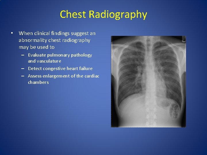 Chest Radiography • When clinical findings suggest an abnormality chest radiography may be used