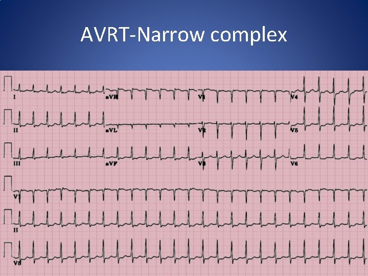 AVRT-Narrow complex 