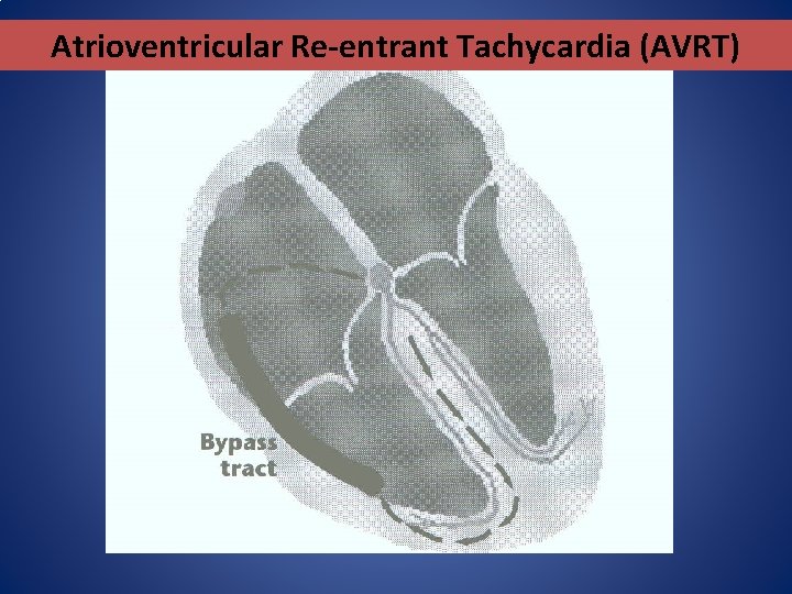 Atrioventricular Re-entrant Tachycardia (AVRT) 