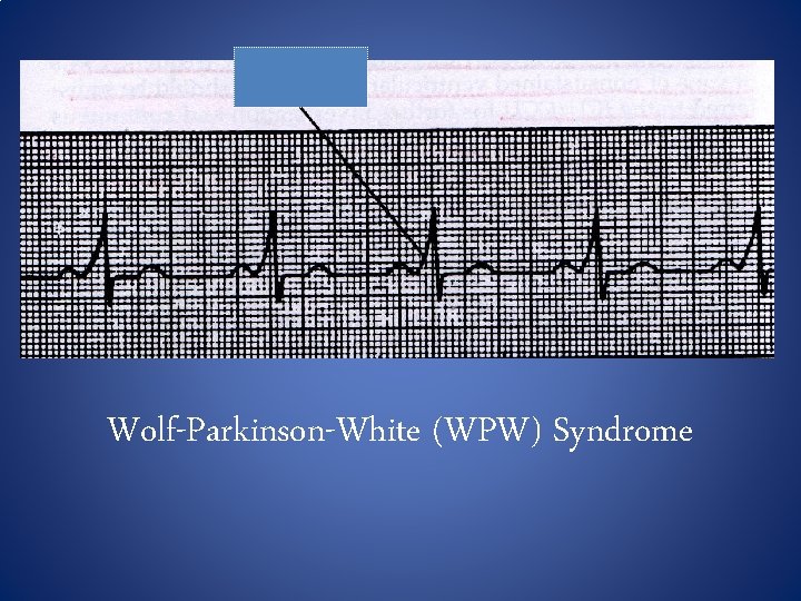 Wolf-Parkinson-White (WPW) Syndrome 