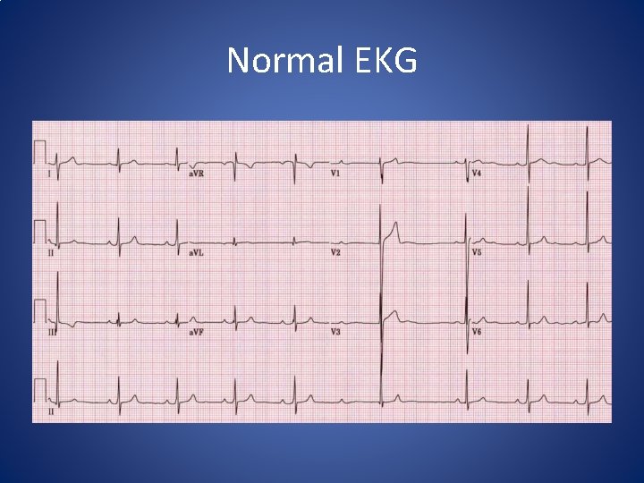 Normal EKG 