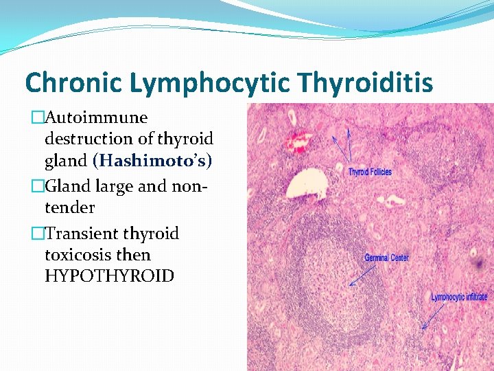 Chronic Lymphocytic Thyroiditis �Autoimmune destruction of thyroid gland (Hashimoto’s) �Gland large and nontender �Transient