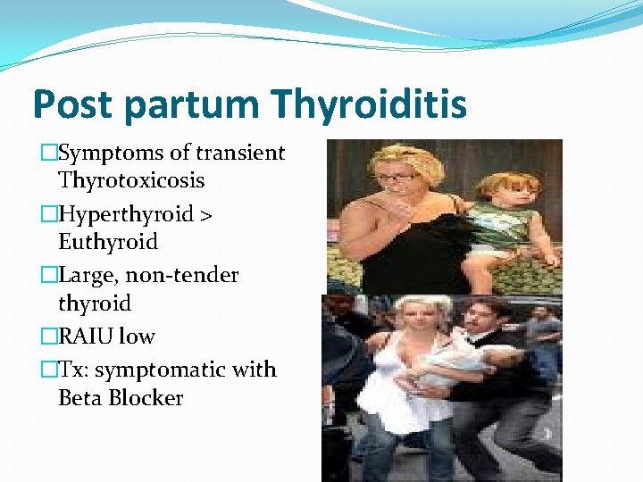 Post partum Thyroiditis �Symptoms of transient Thyrotoxicosis �Hyperthyroid > Euthyroid �Large, non-tender thyroid �RAIU