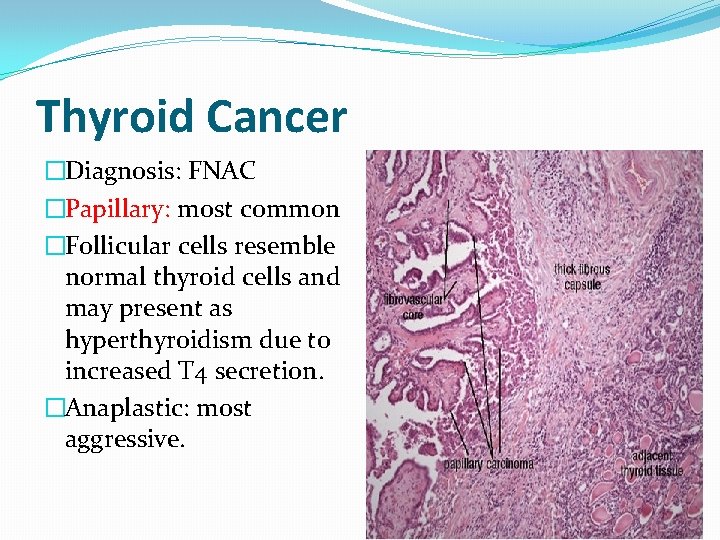 Thyroid Cancer �Diagnosis: FNAC �Papillary: most common �Follicular cells resemble normal thyroid cells and