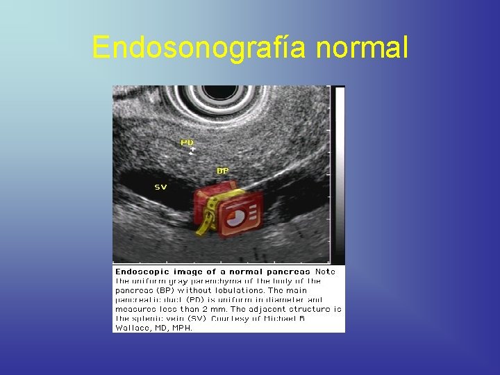 Endosonografía normal 