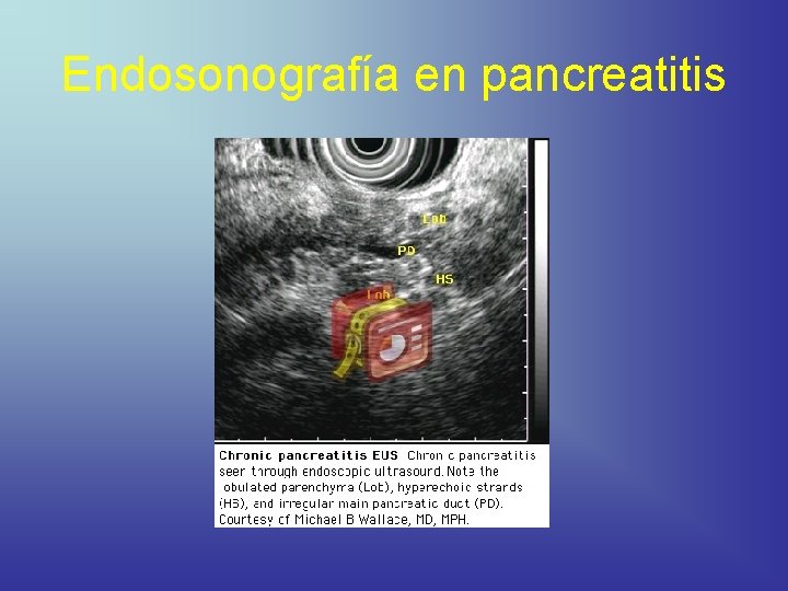 Endosonografía en pancreatitis 