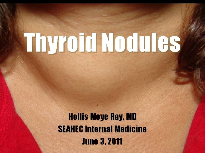 Thyroid Nodules Hollis Moye Ray, MD SEAHEC Internal Medicine June 3, 2011 