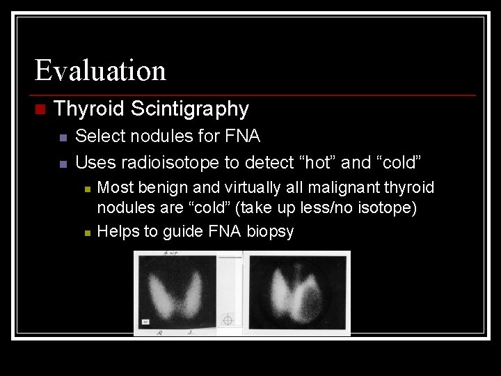 Evaluation n Thyroid Scintigraphy n n Select nodules for FNA Uses radioisotope to detect