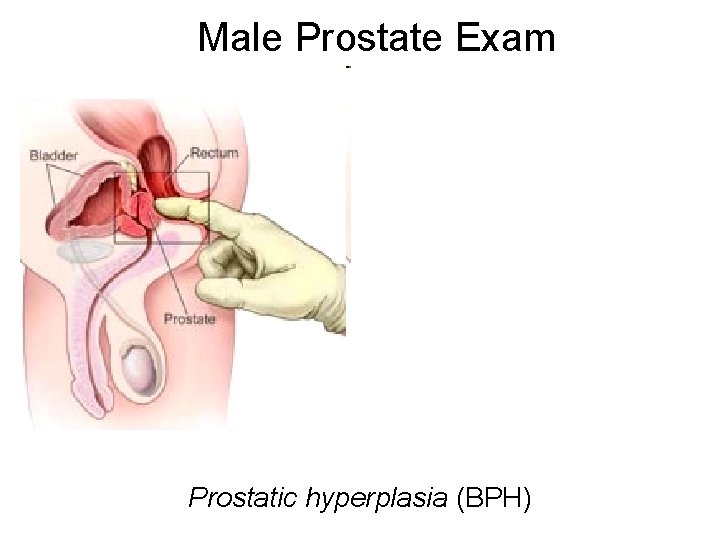 Male Prostate Exam Prostatic hyperplasia (BPH) 