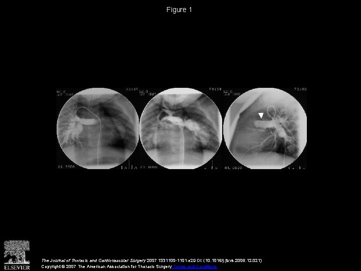 Figure 1 The Journal of Thoracic and Cardiovascular Surgery 2007 1331100 -1101. e 2