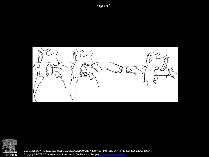 Figure 2 The Journal of Thoracic and Cardiovascular Surgery 2007 1331100 -1101. e 2