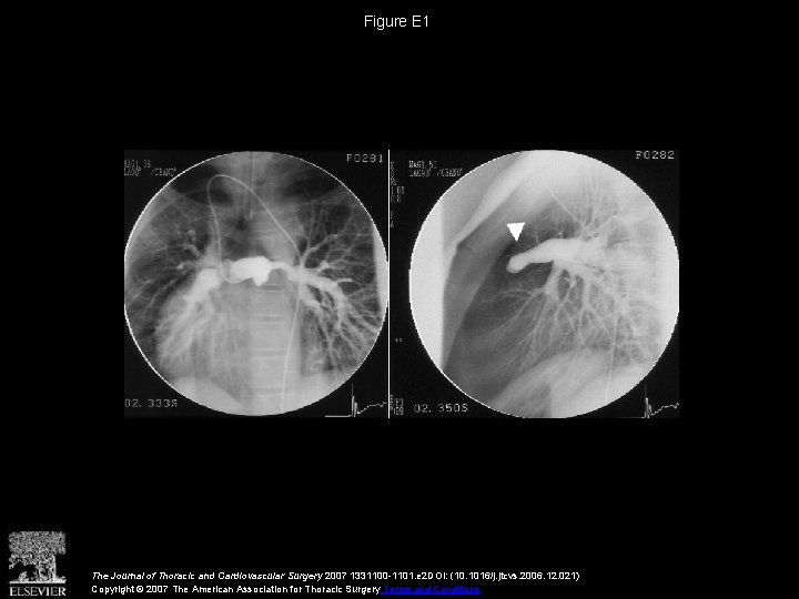 Figure E 1 The Journal of Thoracic and Cardiovascular Surgery 2007 1331100 -1101. e