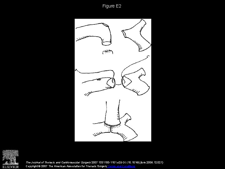 Figure E 2 The Journal of Thoracic and Cardiovascular Surgery 2007 1331100 -1101. e