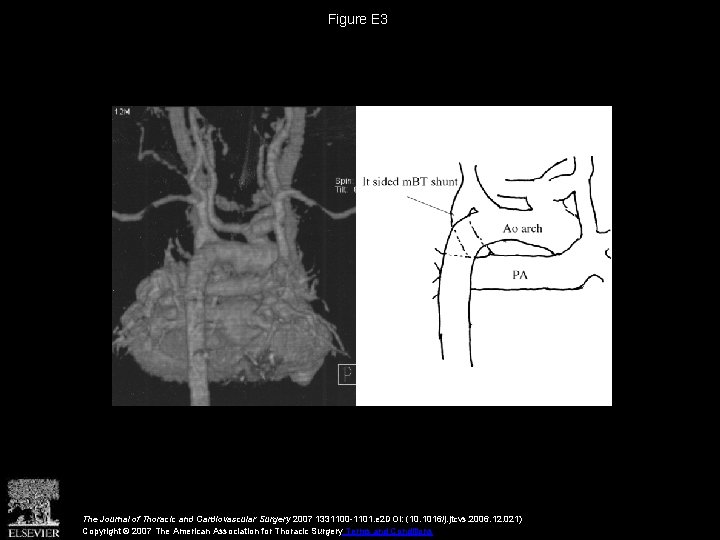 Figure E 3 The Journal of Thoracic and Cardiovascular Surgery 2007 1331100 -1101. e