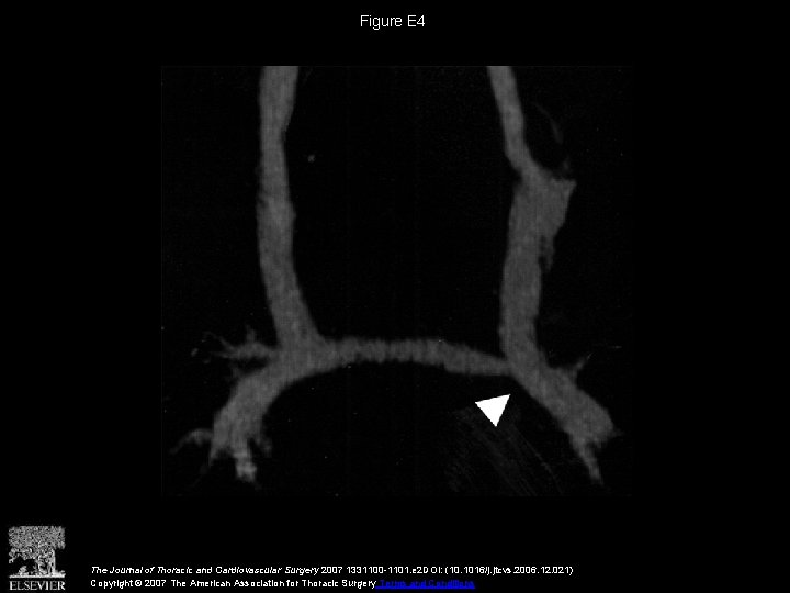 Figure E 4 The Journal of Thoracic and Cardiovascular Surgery 2007 1331100 -1101. e