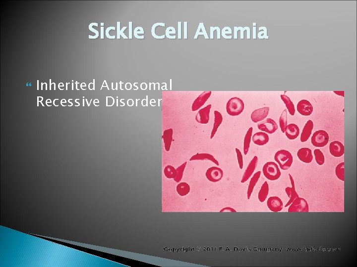 Sickle Cell Anemia Inherited Autosomal Recessive Disorder 