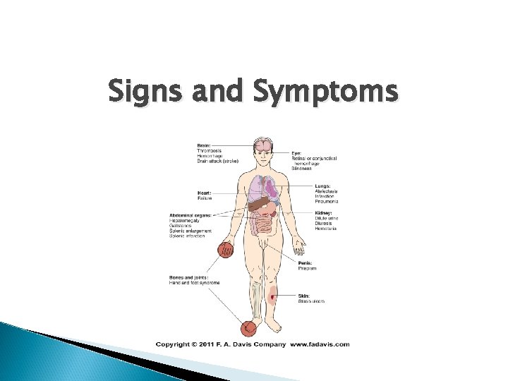 Signs and Symptoms 