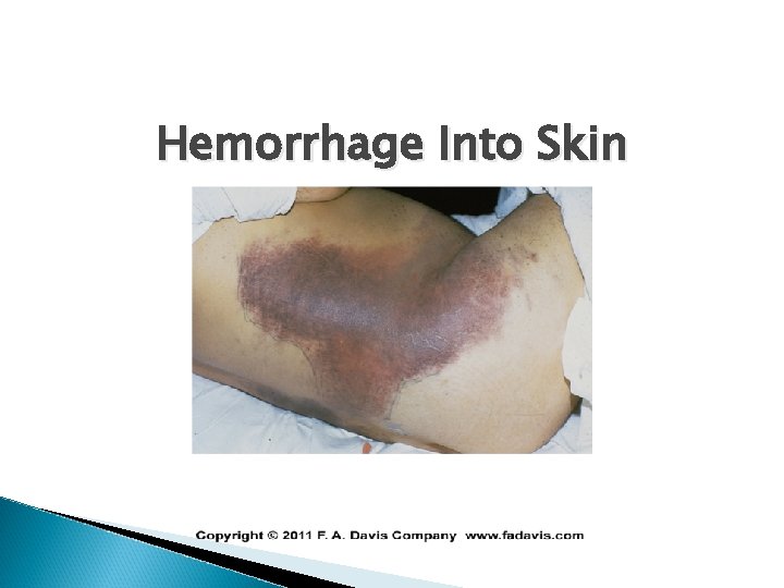 Hemorrhage Into Skin 