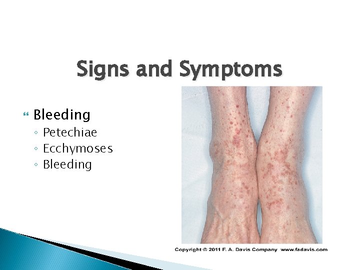 Signs and Symptoms Bleeding ◦ Petechiae ◦ Ecchymoses ◦ Bleeding 