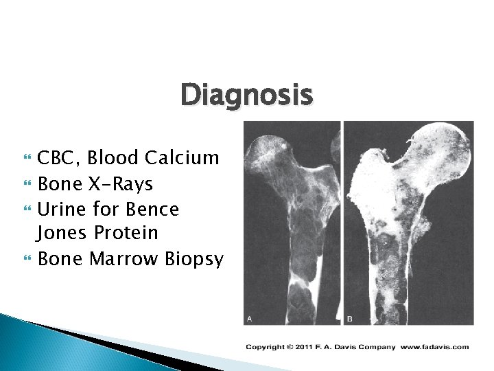 Diagnosis CBC, Blood Calcium Bone X-Rays Urine for Bence Jones Protein Bone Marrow Biopsy