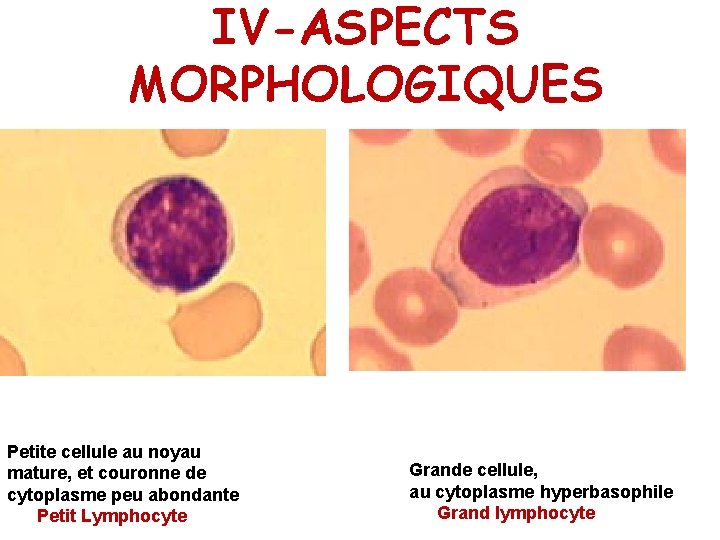 IV-ASPECTS MORPHOLOGIQUES Petite cellule au noyau mature, et couronne de cytoplasme peu abondante Petit