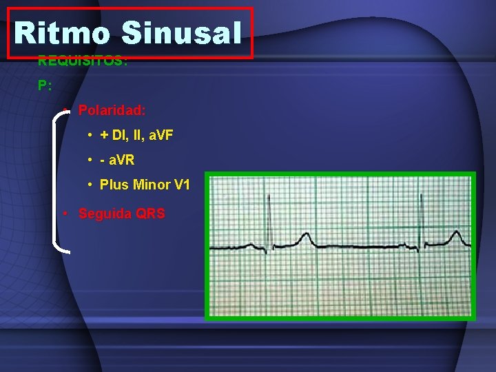 Ritmo Sinusal REQUISITOS: P: • Polaridad: • + DI, II, a. VF • -