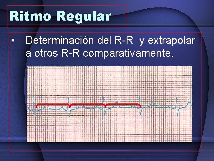 Ritmo Regular • Determinación del R-R y extrapolar a otros R-R comparativamente. 