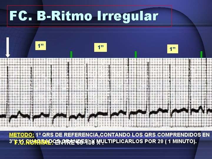 FC. B-Ritmo Irregular 1’’ 0. 20’’ 1’’ 3’’ METODO: 1º QRS DE REFERENCIA, CONTANDO