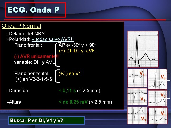 ECG. Onda P Normal -Delante del QRS -Polaridad: + todas salvo AVR!! Plano frontal: