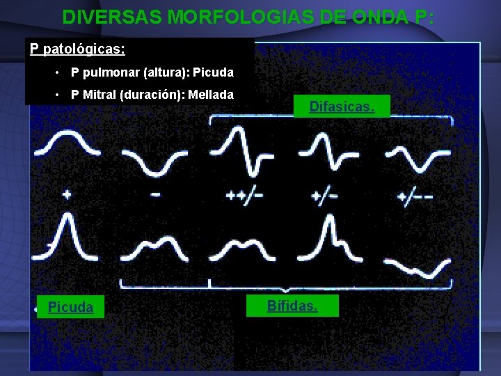 DIVERSAS MORFOLOGIAS DE ONDA P: P patológicas: • P pulmonar (altura): Picuda • P